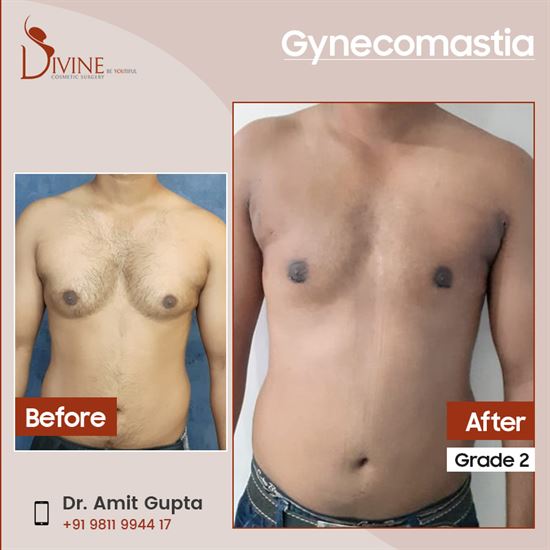 42 30 Minute Post gynecomastia surgery workout for Girls