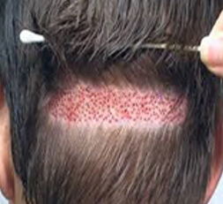 Long Hair Transplant