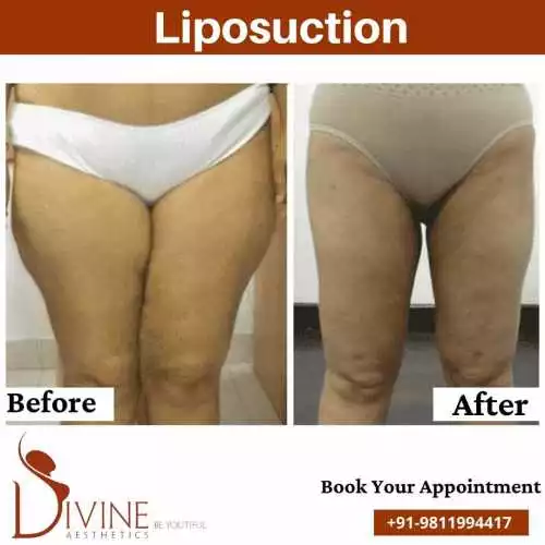 Thigh Liposuction before after