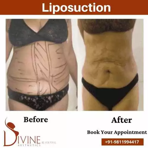Abdomen Liposuction before after