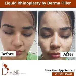 nose filler before after pictures