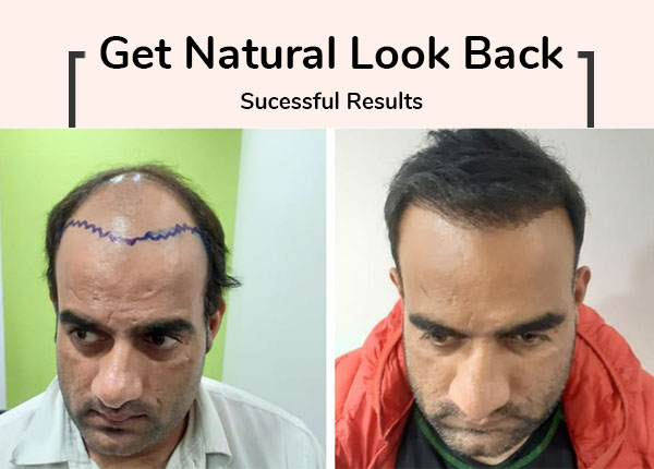 FUE Hair Transplant in Delhi & Gurgaon | Follicular Unit Extraction