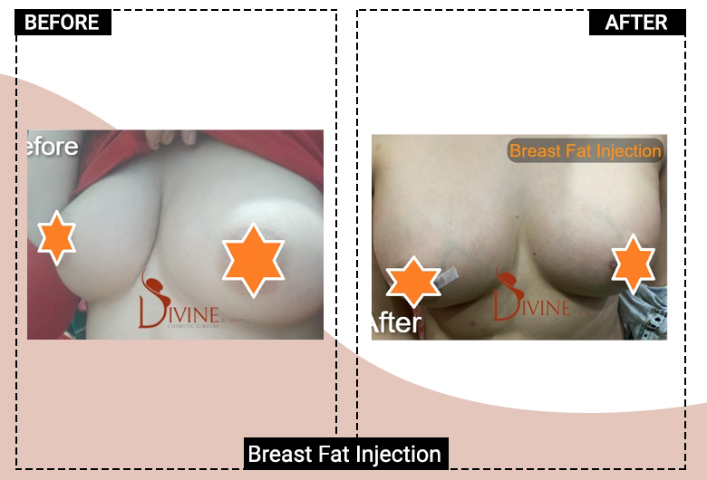 A to Z of Breast Fat Transfer By Dr. Amit Gupta  Pros and Cons of Breast  Fat Injection 