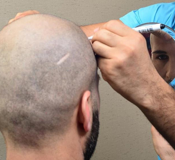 The risk involved in Failed Hair Transplant Repair