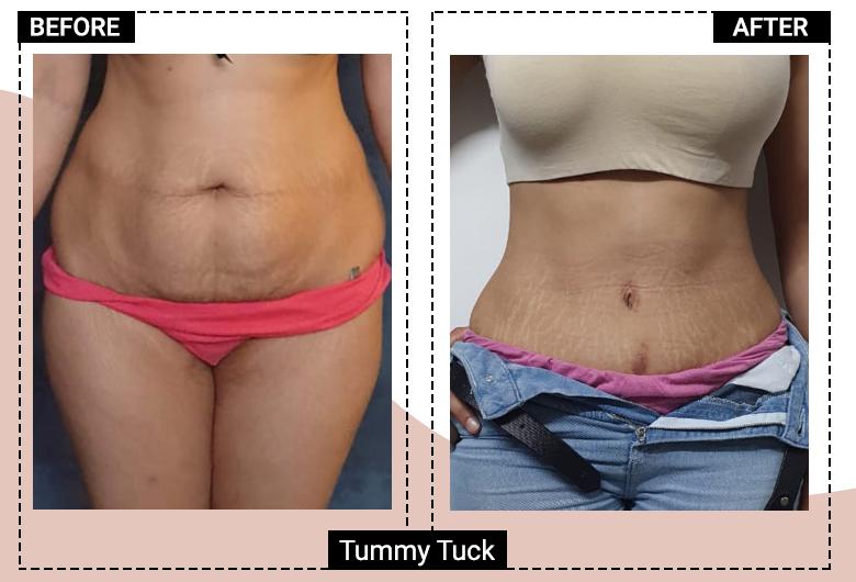 Tummy Tuck Delhi by the best Surgeon- Divine Cosmetic Surgery