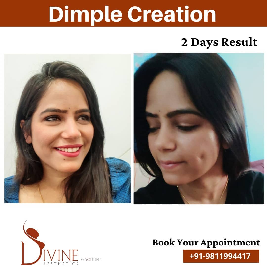 How To Get Dimples On Face Dimple Surgery Cost