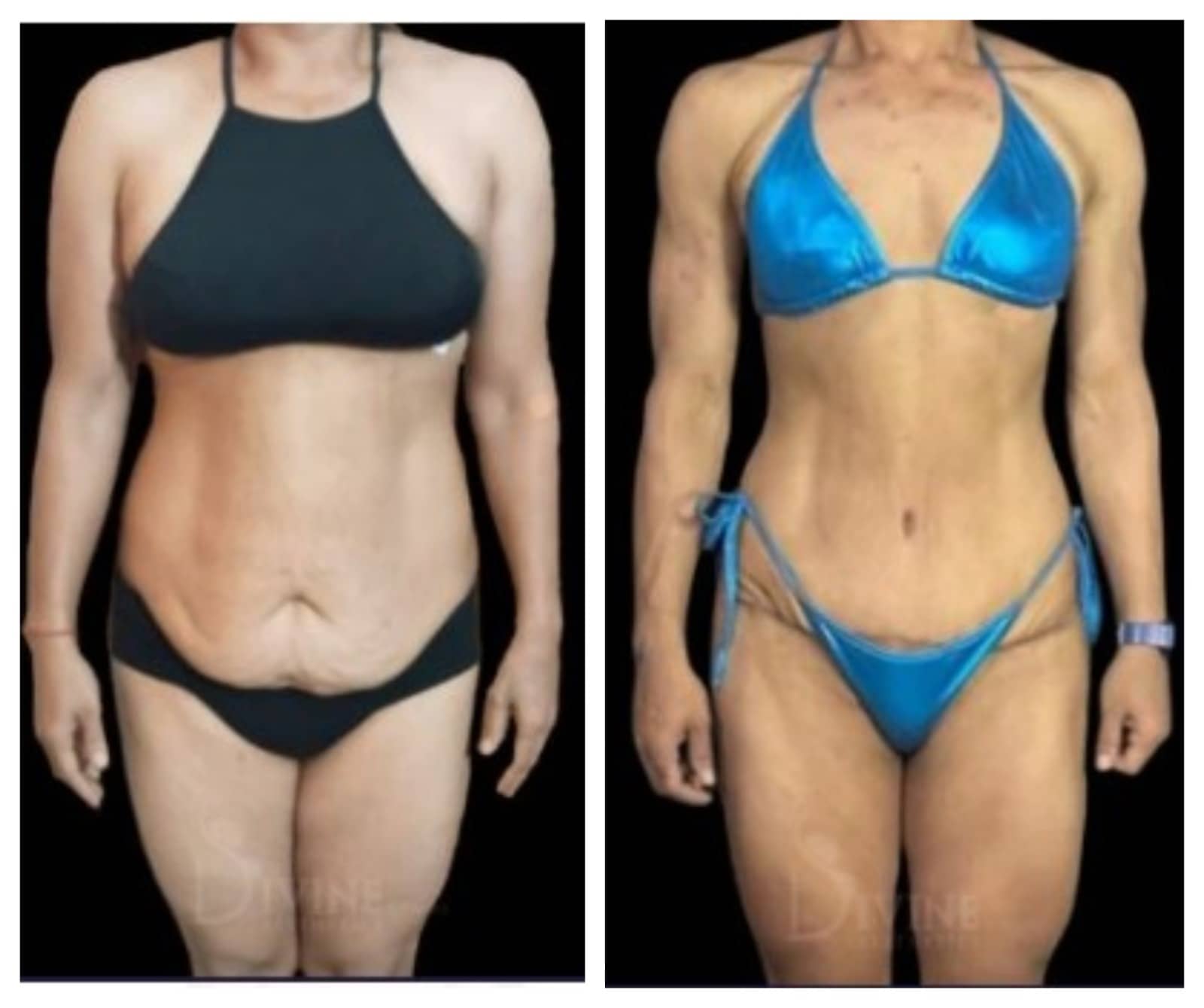 https://www.divinecosmeticsurgery.com/wp-content/uploads/2023/06/Tummy-Tuck-Surgery-Before-and-After-Photo.jpeg