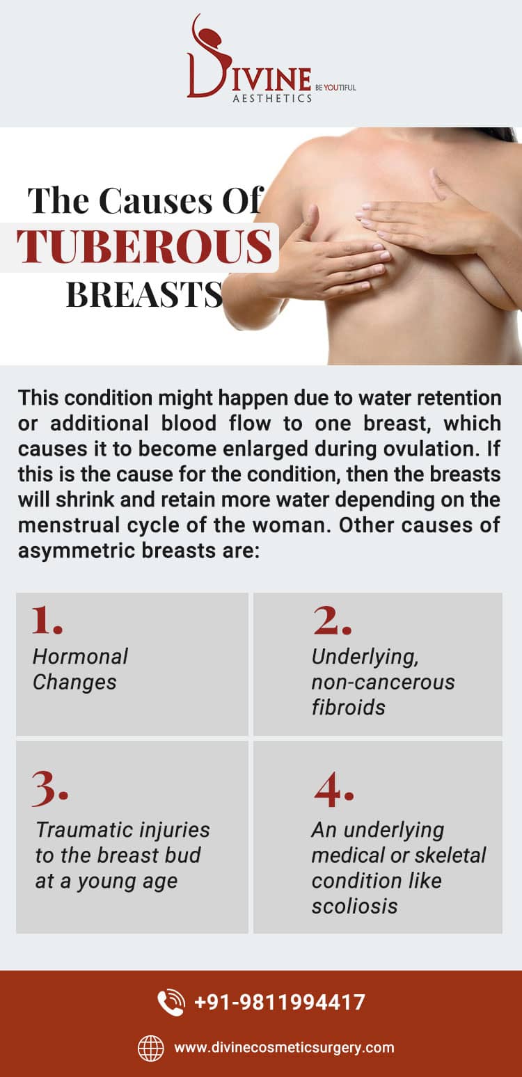 Asymmetric breast development.