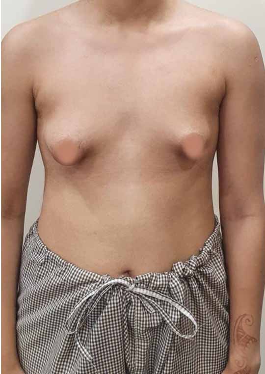 https://www.divinecosmeticsurgery.com/wp-content/uploads/2023/07/Tuberous-breast-1.jpg