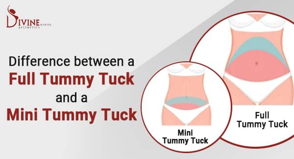 Mini Tummy Tuck vs. Full Tummy Tuck: Choosing the Right Procedure