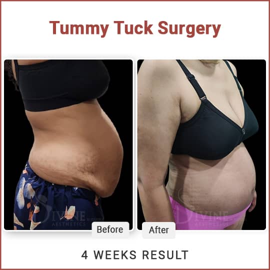 Am I a good candidate for a tummy tuck? : r/tummytucksurgery