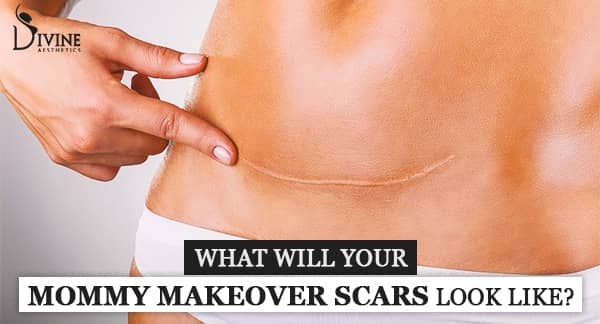  What will your mommy makeover scars look like