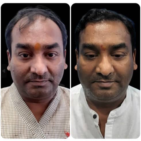 unshaven hair transplant result in India