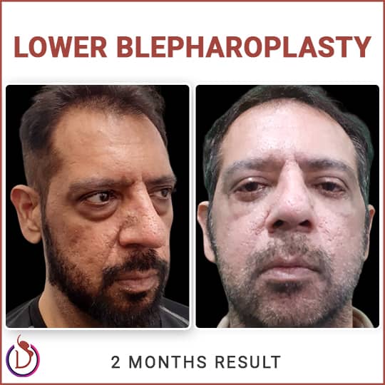 Facial Skin Tightening - Blepharoplasty