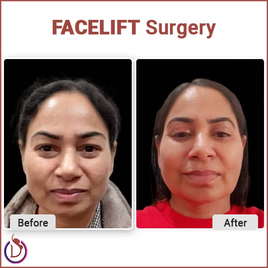 Facial Skin Tightening Treatments - facelift 