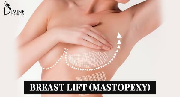 Breast lift or mastopexy